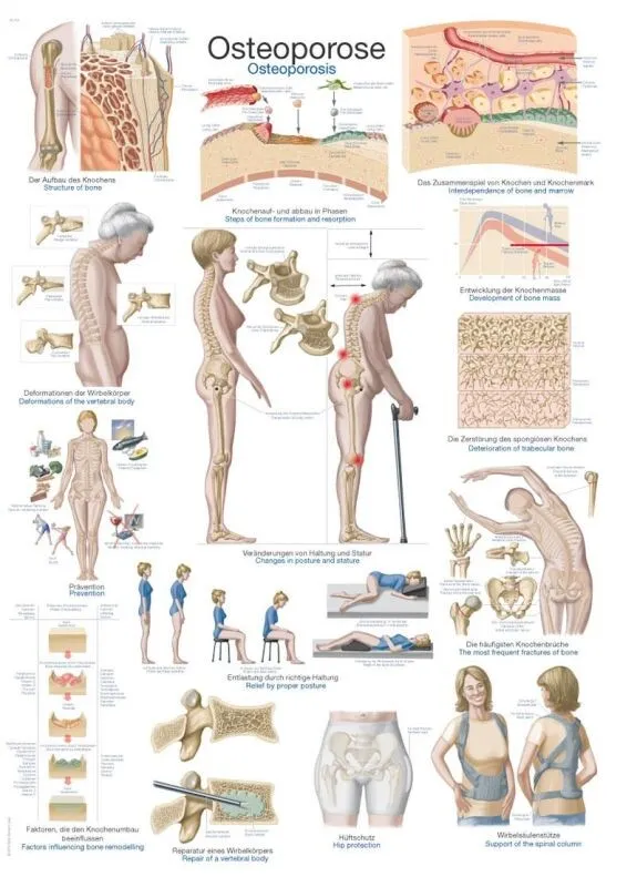 Plansch Osteoporos, Anatomisk Affisch 50x70cm